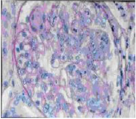 Gambar 10. Histopatologi glomerulonefritis dengan mikroskop elektron  keterangan gambar : 