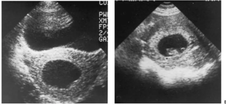 Gambar  1.  Gambaran  USG  Blighted  Ovum  Dibandingkan  dengan  Kehamilan  Normal 