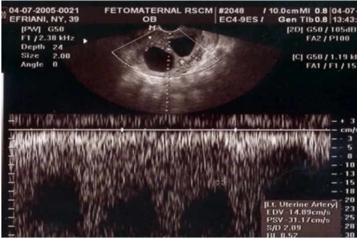 Gambar 2. Blighted ovum pada uterus bicornu unicolis 
