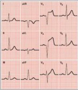 Gambar 1. Hasil pemeriksaan EKG pada pasien STEMI  Lokasi infark miokard berdasarkan perubahan gambaran EKG 