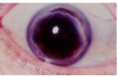Gambar 8.  Mooren's Ulcer d. Ring Ulcer