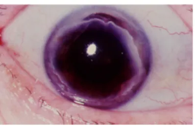 Gambar 8.  Mooren's Ulcer d. Ring Ulcer