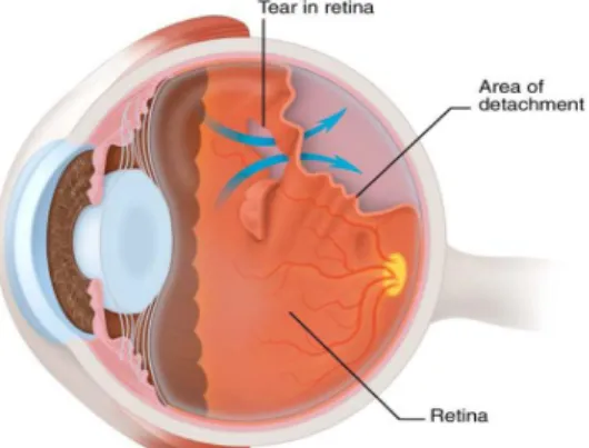 Gambar 1. Ablasio retina