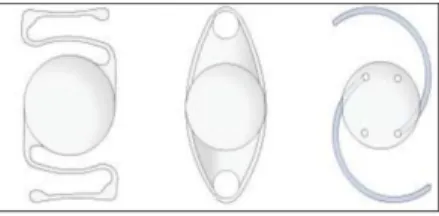 Gambar 1: Tipe Lensa Intraokular: A.Kelman Multiflex (lensa intraokular COA); B. Lensa Penjepit Iris Singh&amp; Worst’s; C