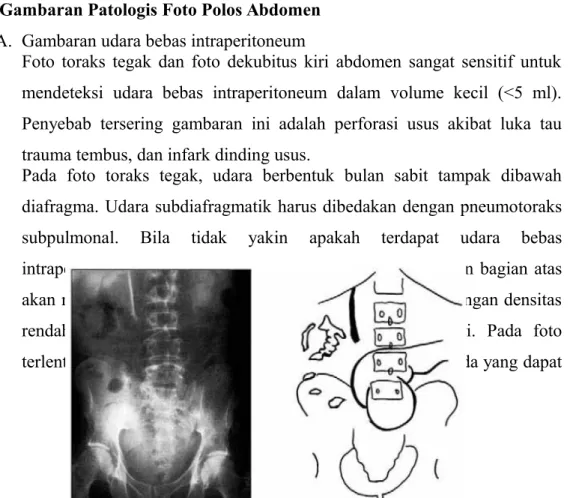 Foto toraks tegak dan foto dekubitus kiri abdomen sangat sensitif untuk mendeteksi   udara   bebas   intraperitoneum   dalam   volume   kecil   (&lt;5   ml).