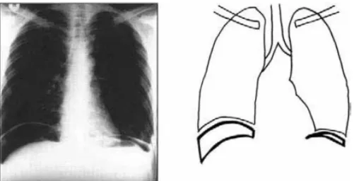 Gambar 2.9. Foto terlentang abdomen menunjukkan udara bebas intraperitoneum. Perhatikan ligamentum falsiforme di kuadran kanan atas dan