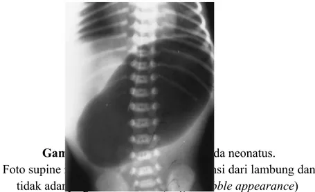 Gambar 2.13. Atresia pylorum pada neonatus.