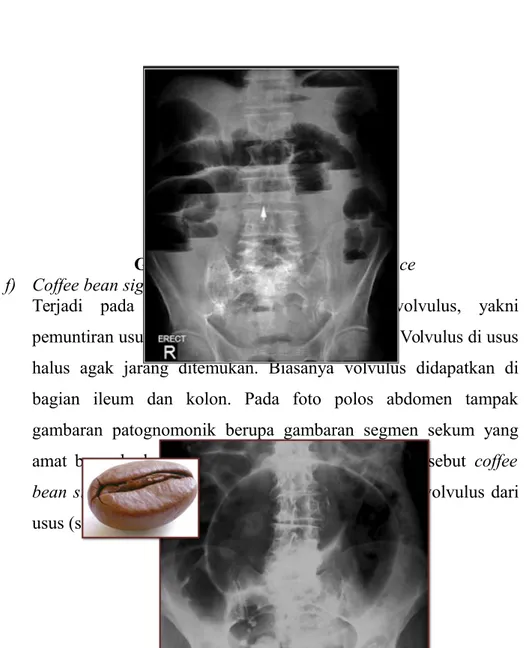 Gambar 2.17. Step ladder appearance f) Coffee bean sign