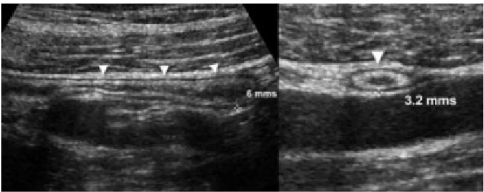 Gambar 10. Apendiks normal. A dan B, longitudinal A) dan transversal (B) sonogram, menunjukkan apendiks (panah) dengan diameter kurang dari 7 mm cut-off point, dikelilingi oleh lemak noninflamed normal 16