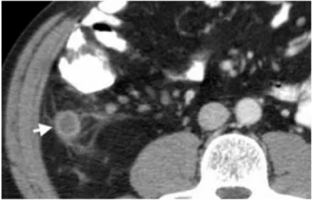 Gambar   13.  Apendisitis.   CT   Scan   dengan   kontras   menggambarkan apendiks   yang   mengalami   distensi   dan   berisi   cairan   (panah)   dengan periappendiceal fat-stranding