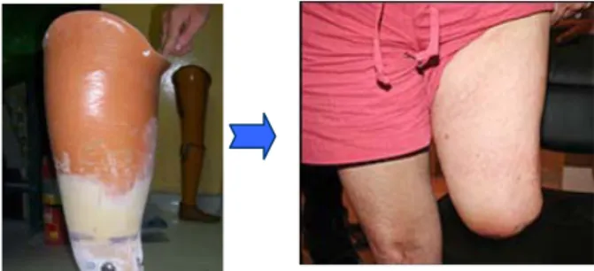 Gambar 1. Socket Prosthesis dan Stump [2] 