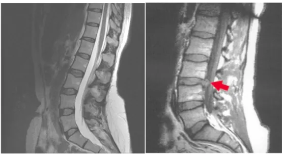Gambar 6. MRI dari columna vertebralis normal (kiri) dan mengalami herniasi (kanan)