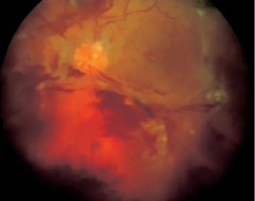 Gambar 6. Ablasio retina traksi