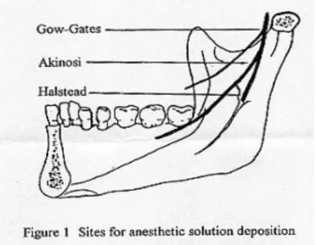 Gambar 4. Lokasi anestesi untuk rahang bawah 