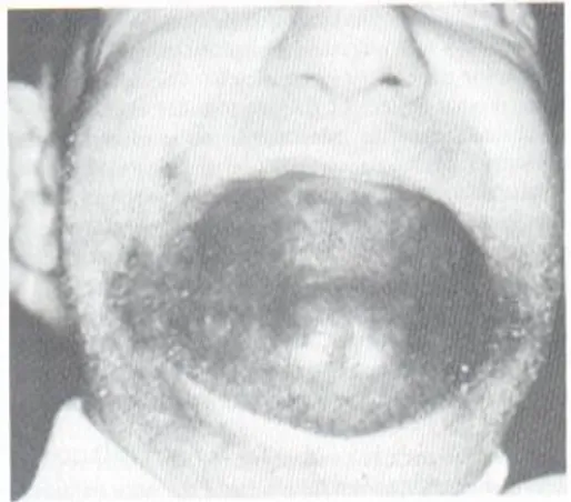 Gambar 2. Hematoma akibat blok nervus mentale bilateral 