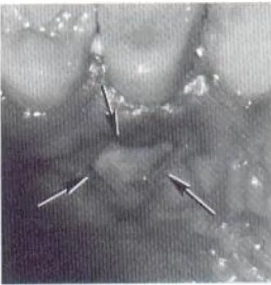 Gambar 3. Pengelupasan jaringan pada palatum akibat iskemia sekunder yang lama akibat  local anastesi dengan vasonkonstriktor 