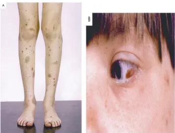 Gambar 2.2 Gejala Klinis ITP. (Dalam: Cines DB, Blanchette VS, Chir B. Immune Thrombocytopenic Purpura