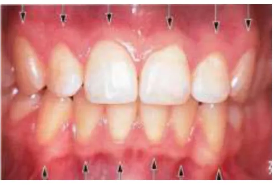 Gambar 2. Gingiva normal bagian palatal  (Lindhe, dkk., 2003) 