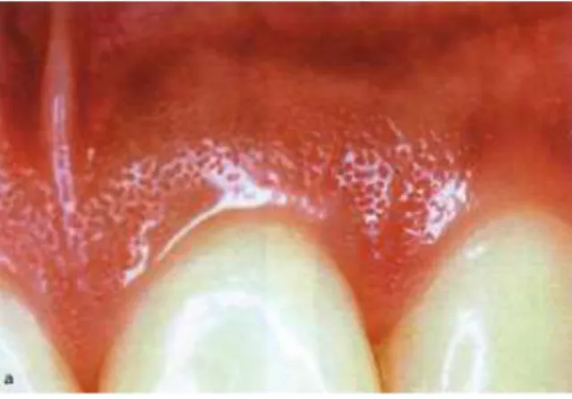 Gambar 6. Stippling pada gingiva cekat 