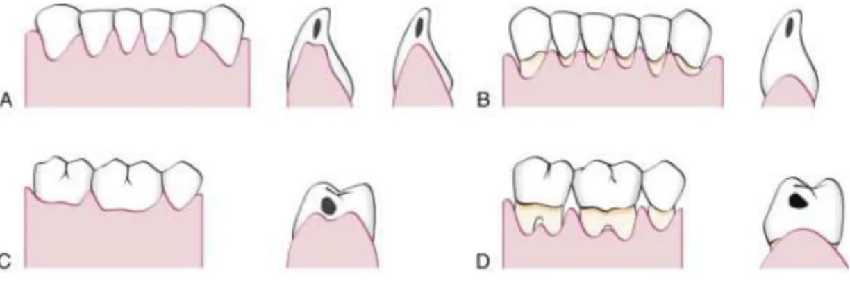 Gambar 7. Interdental gingiva 
