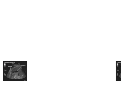 Gambar 4. Gambaran USG prenatal pada atresia duodenalGambar 4. Gambaran USG prenatal pada atresia duodenal Post natal