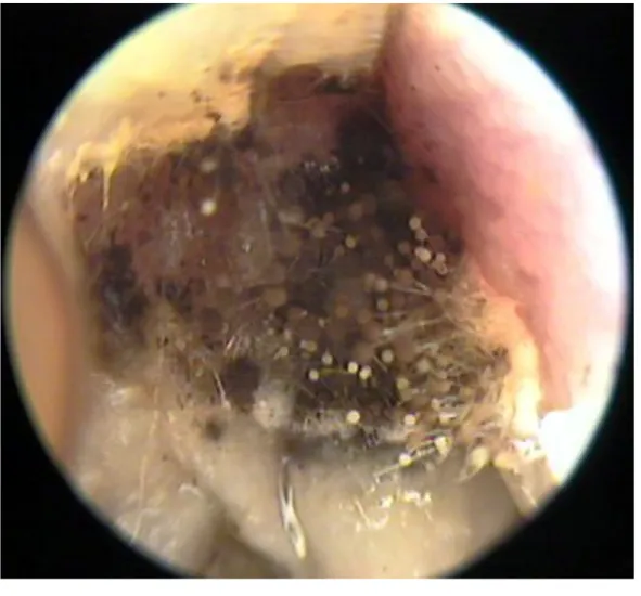 Gambar 1 : Otomikosis. Tampak hifa dan spora dalam liang telinga 