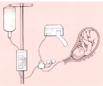 Gambar 7. Prosedur amnioinfusion 2.7.2. Transabdominal Amnioinfusion 18