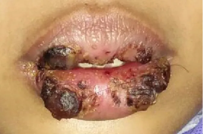 Gambar 1. Kondisi klinis ekstraoral pasien. Terdapat lesi pada  bibir atas dan bawah.