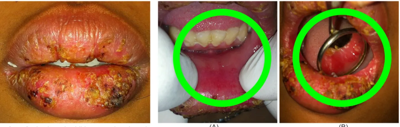 Gambar 2. Lesi pada bibir atas dan bawah  mengalami perbaikan.
