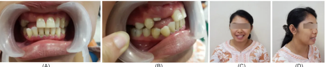 Gambar 1. Sebelum dilakukan perawatan, (A) Gambaran intraoral tampak depan, (B) Gambaran intraoral tampak samping, (C)  Gambaran ekstraoral tampak depan, (D) Gambaran ekstraoral tampak samping.