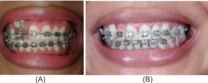 Gambar 4. (A) Situasi gigi kaninus sebelum gigi 12 digeser ke  sisi distal 11, (B) Posisi gigi 13 dan gigi 12 berhasil di tempatkan  di lokasi yang benar dalam lengkung gigi rahang atas.
