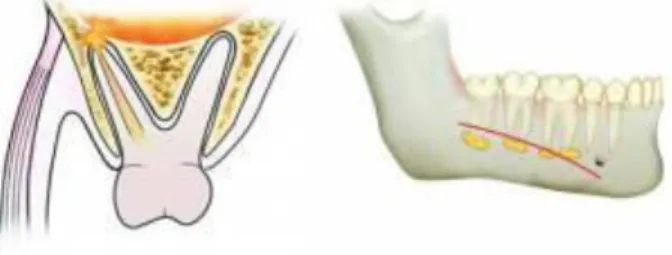 Gambar  2.8:  Ilustrasi  penyebaran  infeksi  odontogen  (dentoalveolar  abcess)  tergantung  pada  posisi  apeks  gigi  penyebab