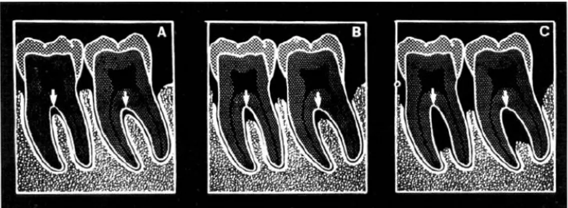 Gambar  3.  Diagram  radiografi  macam-macam  keterlibatan  furkasi.  A.  Awal  keterlibatan  furkasi,  pelebaran  ligamen  periodontal  pada  furkasi  B