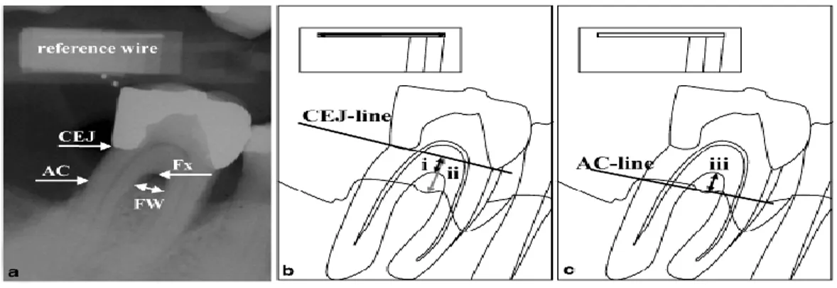 Gambar  4.  (a-c)  Kelas  II  Cacat  furkasi  pada  aspek  lingual  molar  pertama  mandibula  kanan   (a)  radiograf:  CEJ:  cemento-enamel  junction  (dalam  hal  ini  dilihat  dari  margin  restorasi),   AC: crest alveolar, FW: lebar furkasi, Fx: fornik