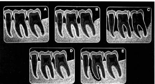 Gambar 5. Diagram ilustrasi variasi gambaran radiografik periodontitis. A. Awalnya terdapat  penurunan  puncak  tulang  alveolar,  pelebaran  ligamen  periodontal  dan  kehilangan  bentuk  normal  antara  puncak  tulang  alveolar  dan  lamina  dura