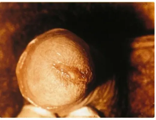 Gambar 9: Infeksi Klamidia
