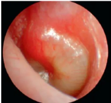 Gambar 3. Membran timpani pada stadium supurasi. 4