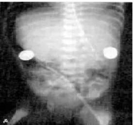 Gambar Pneumoperitonium