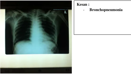 Foto Thorax (28 Desember 2013 