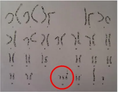 Gambar 2.2 Kromosom trisomi