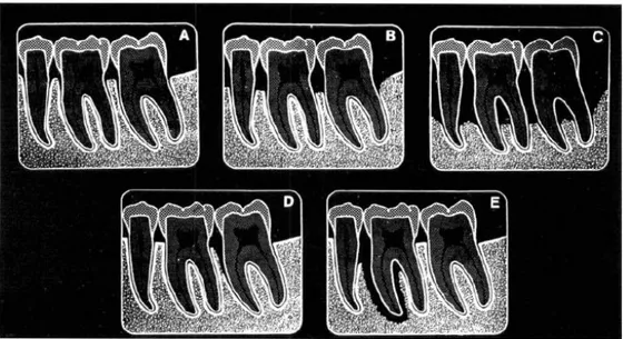 Gambar 5.  Diagram ilustrasi variasi gambaran radiografik periodontitis. A. Awalnya terdapat  penurunan  puncak  tulang  alveolar,  pelebaran  ligamen  periodontal  dan  kehilangan  bentuk  normal  antara  puncak  tulang  alveolar  dan  lamina  dura