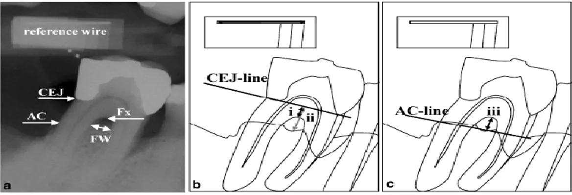 Gambar  4.  (a-c)  Kelas  II  Cacat  furkasi  pada  aspek  lingual  molar  pertama  mandibula  kanan   (a)  radiograf:  CEJ:  cemento-enamel  junction  (dalam  hal  ini  dilihat  dari  margin  restorasi),   AC: crest alveolar, FW: lebar furkasi, Fx: fornik