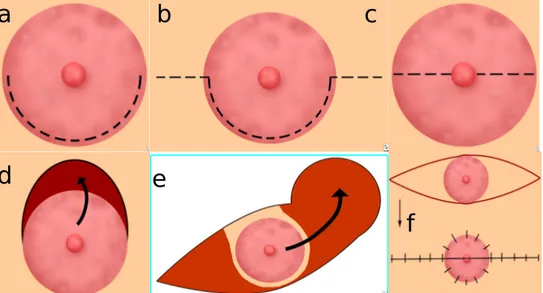 Gambar  3. (a) Webster incision, (b) Webster incision yang diperlebar kearah medial dan lateral, (c) Transverse incision, (d) Triple-V incision, (e) Teknik yang paling sering