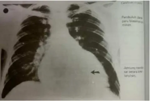Gambar 6. Kardiomiopati 13