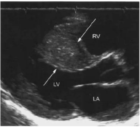 Gambar 8. Asymmetric septal hypertrophy 15