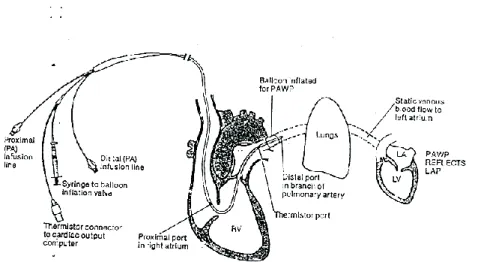 Gambar 1. Kateter pulmonal dan lintasan pemasangan kateter pulmonal. 