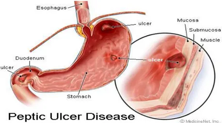 Gambar 2.1. Peptic Ulcer 