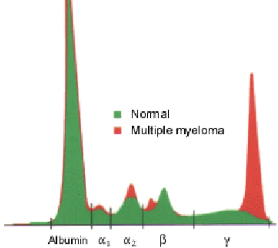 Gambar  1.  Elektroforesis  protein  serum  pada  mieloma  multiple  menunjukkan  parapotein  yang  abnormal  pada  region  globulin  γ  dengan  penurunan kadar dasar globulin β dan γ