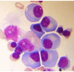 Gambar  2.  Sum-sum  tulang  pada  mieloma  multiple  menunjukkan  sejumlah besar sel plasma, dengan banyak bentuk abnormal