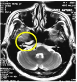 Gambar 1. MRI Otak Pasien 1